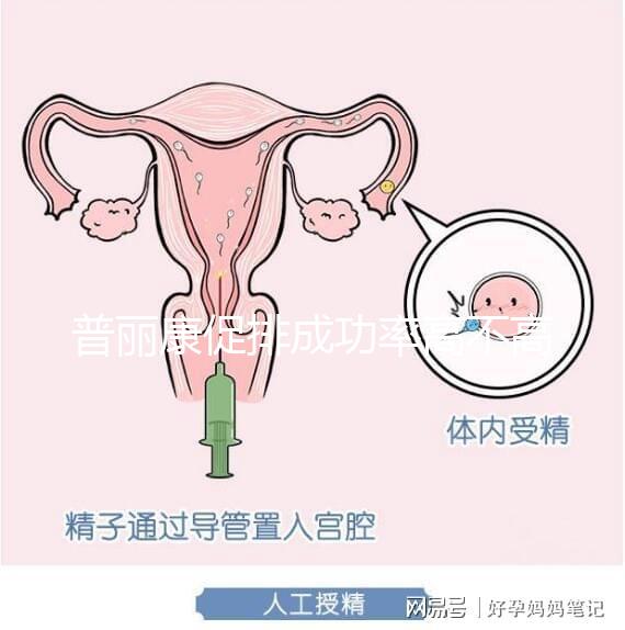 普麗康促排成功率高不高揭秘，能否取出卵泡的關鍵看…